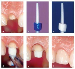 Zirconia En Odontología: Segunda Parte. Revolución Clínica Basada En La ...