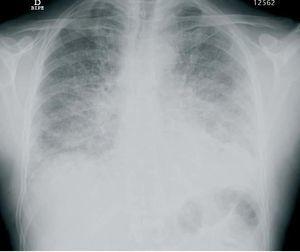 Interstitial Pneumonitis caused by Everolimus | Nefrología