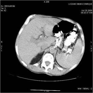 Disseminated tuberculosis with splenic abscessesduring haemodialysis ...