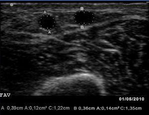 Serial ultrasound of the vascular access | Nefrología