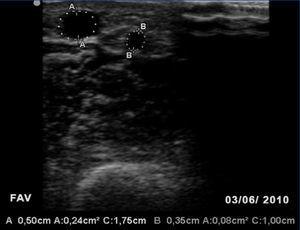 Serial ultrasound of the vascular access | Nefrología