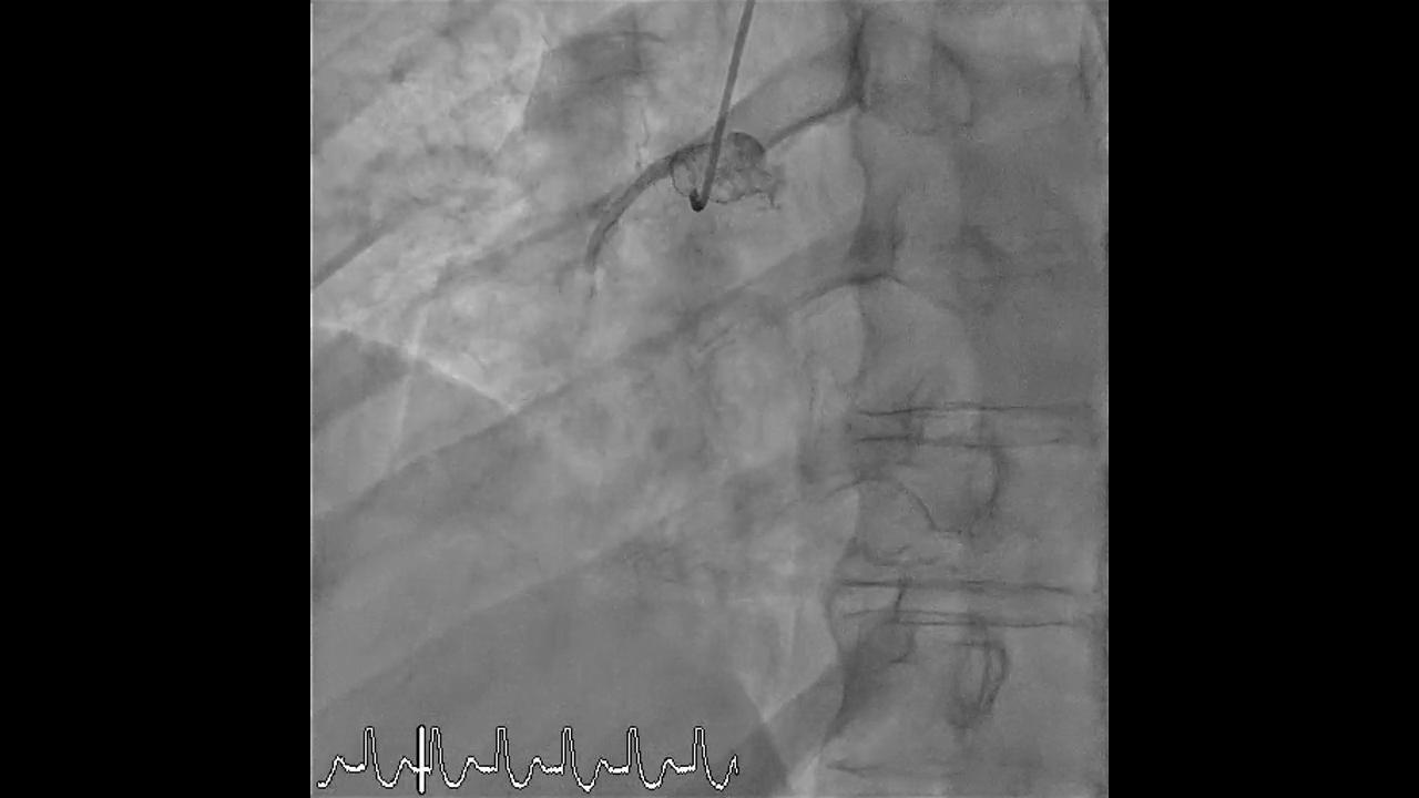 Tako-Tsubo Invertido Como Primer Evento Cardiológico En Un Paciente Con ...