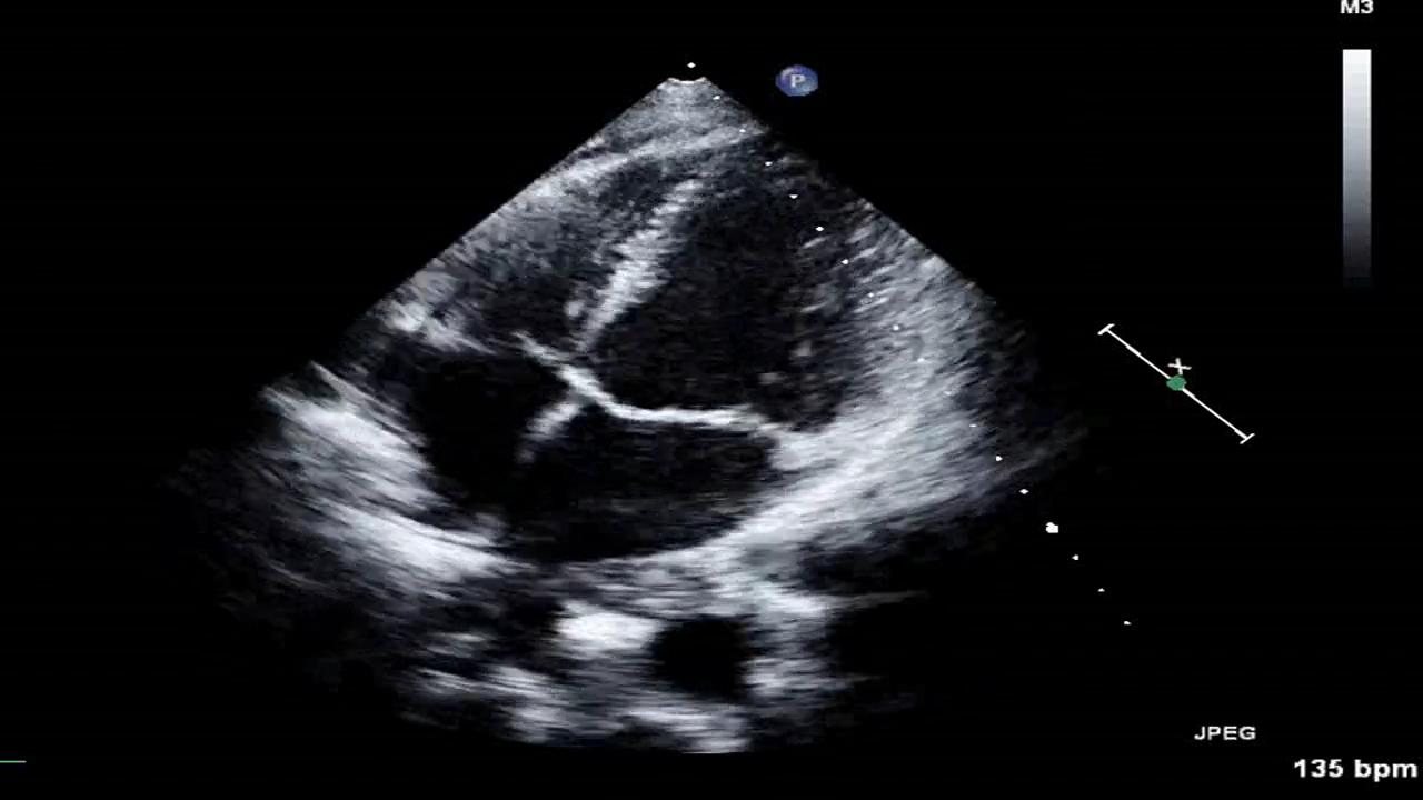 An esophageal lymphoma discovered by echocardiography | Revista ...