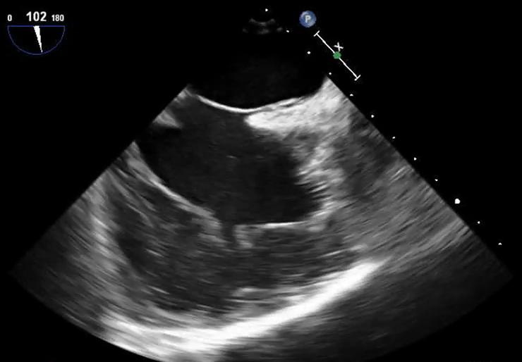 Right Atrium Angiosarcoma: An Unexpected Cause of Stroke | Revista ...