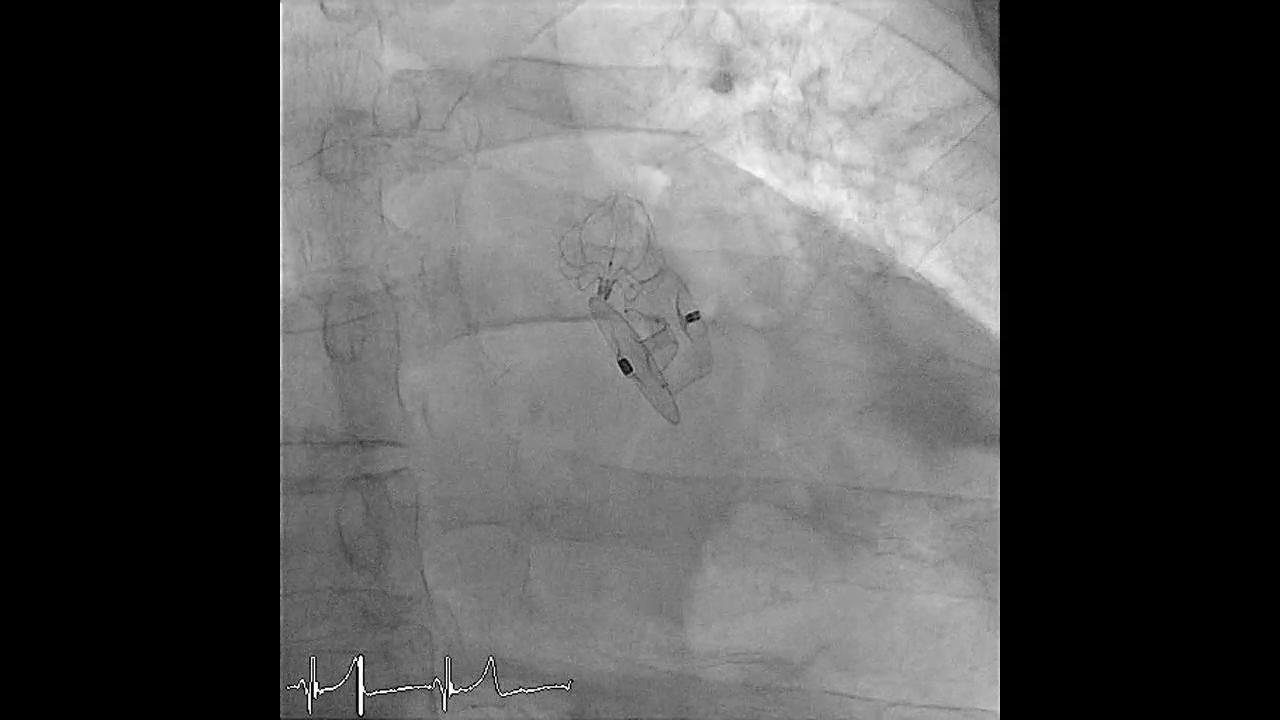 Left Atrial Appendage Closure With 2 Different Devices | Revista ...