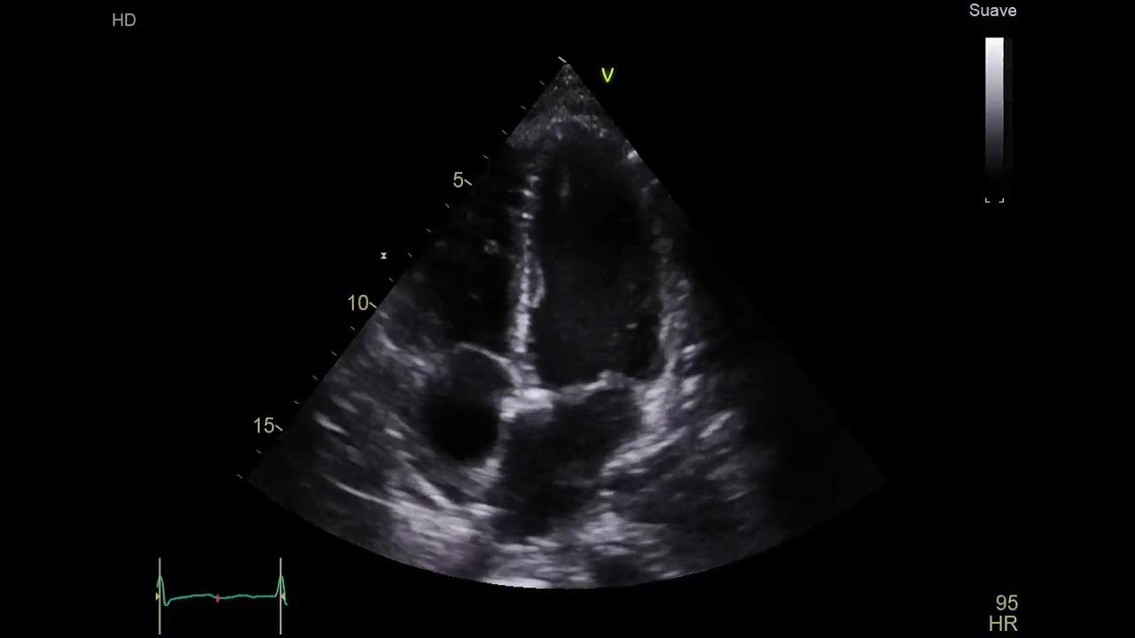 An adolescent girl with severe biventricular dysfunction and pediatric ...