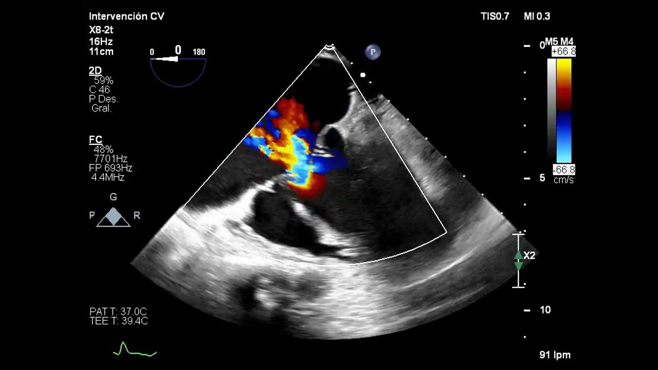 Transfemoral Transcatheter Tricuspid Valve Replacement With The