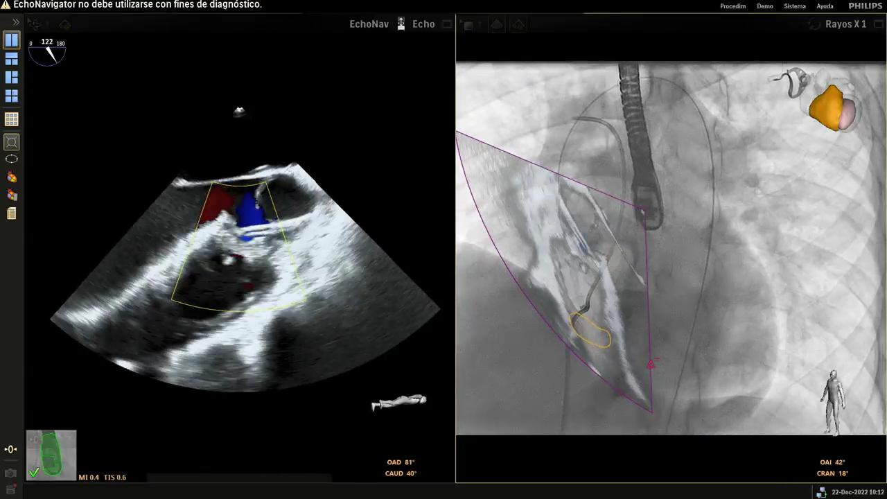 Percutaneous VSD closure with the KONAR-MF occluder: fusion helps ...