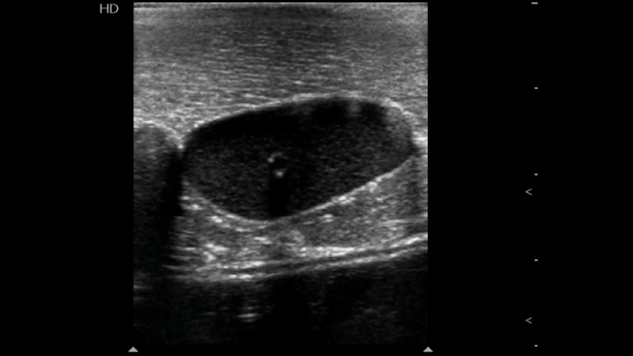 Ultrasound-guided Vascular Cannulation In Critical Care Patients: A ...