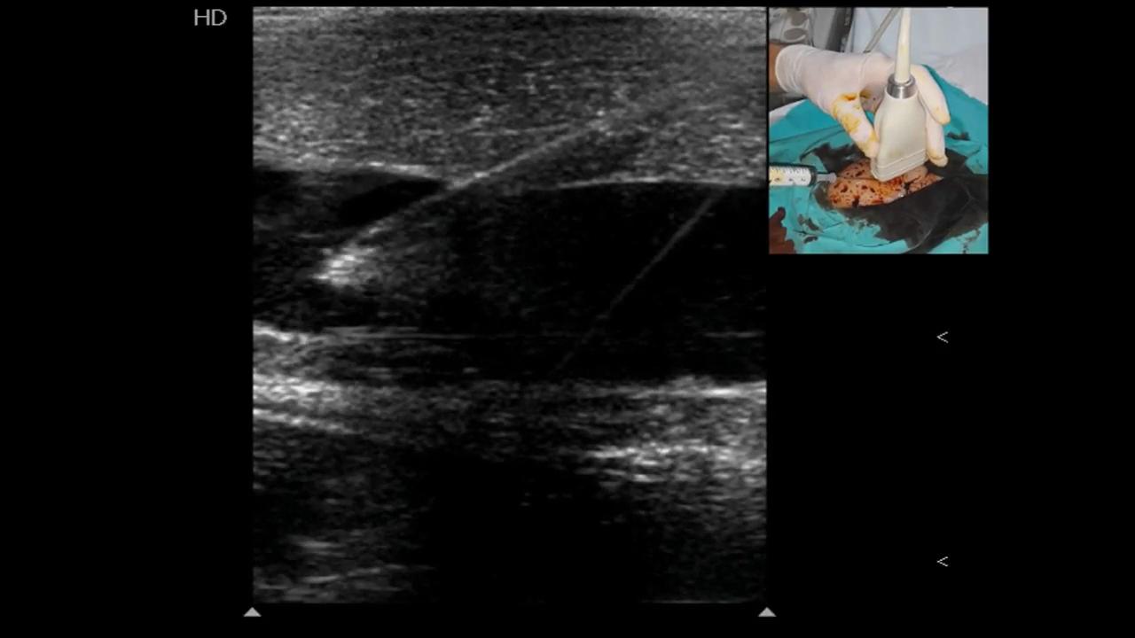 Ultrasound-guided Vascular Cannulation In Critical Care Patients: A ...