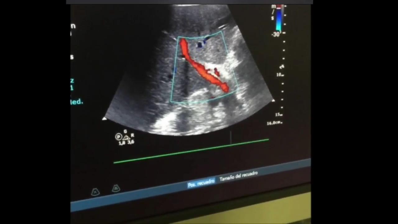 Abdominal ultrasound and VExUS score in critical care | Medicina Intensiva