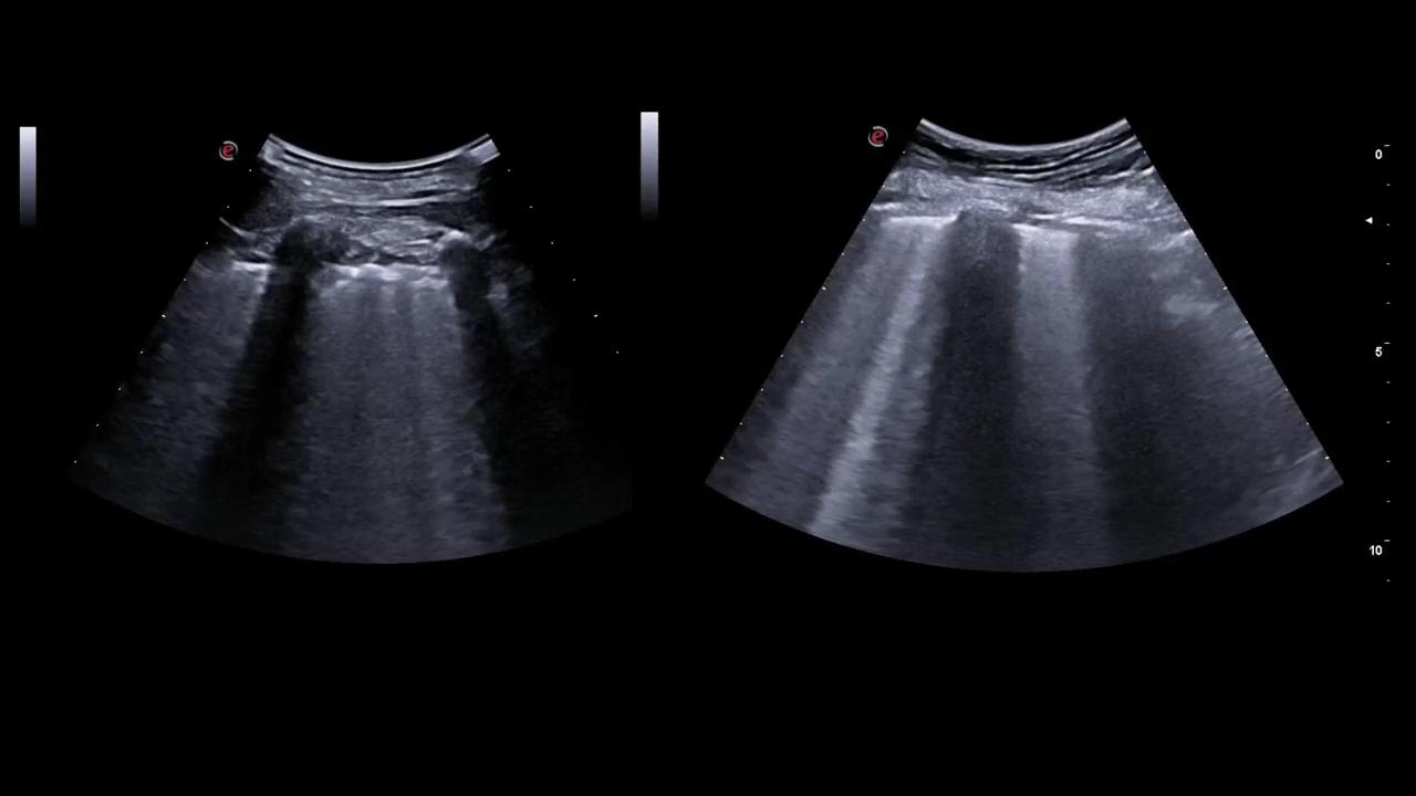 Lung Ultrasound In Heart Failure | Revista Clínica Española